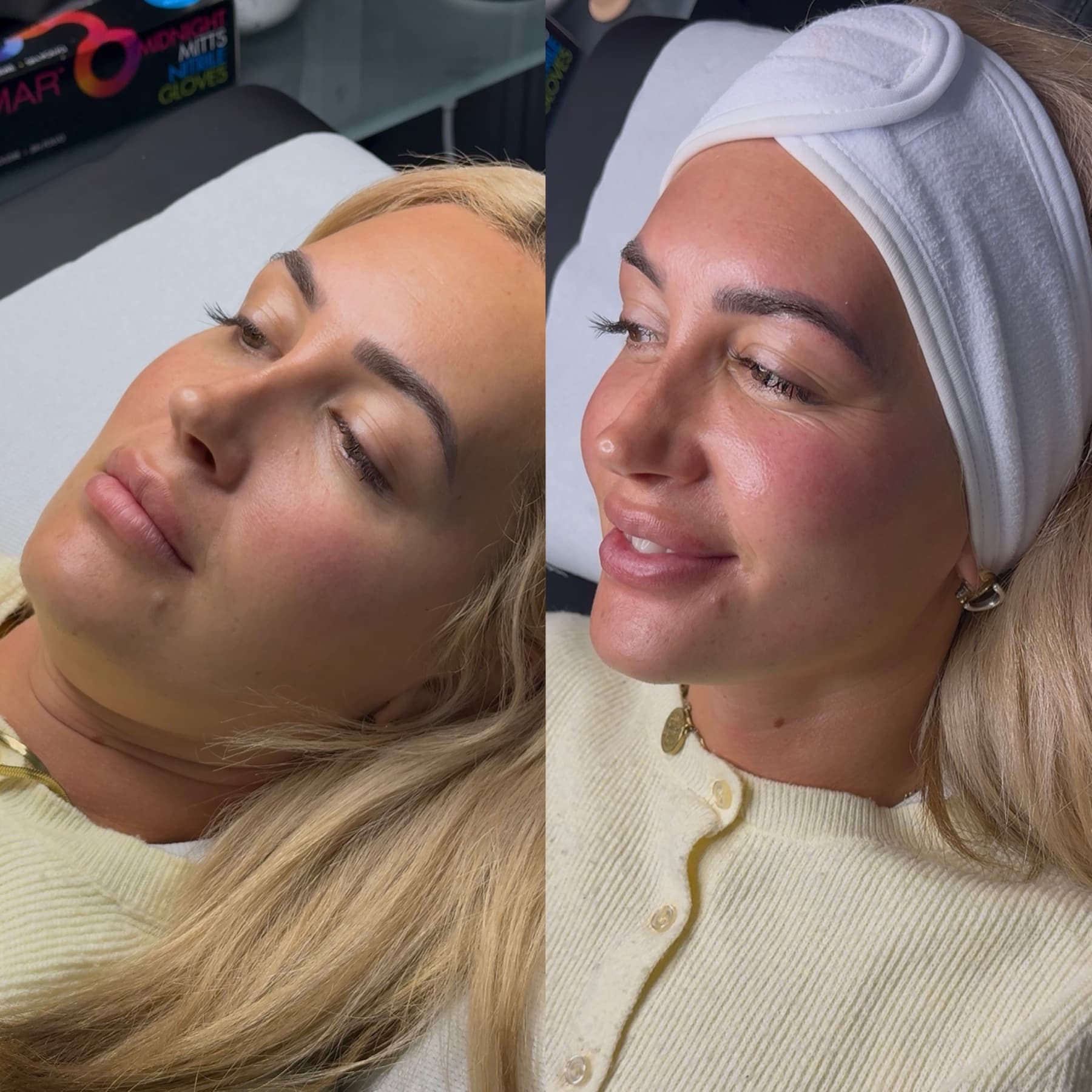 Non-surgical face sculpt before and after at Ella’s Beauty — lifted, glowing skin